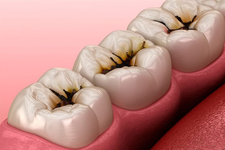 gingivitis