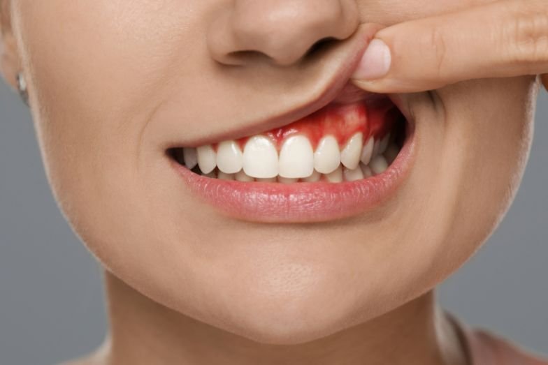 gingivitis